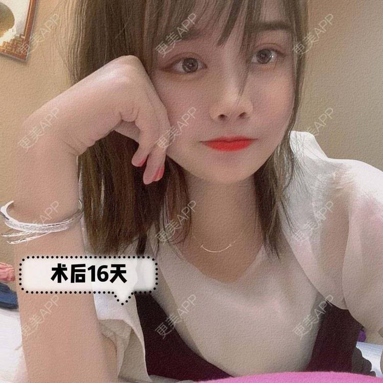 更美 - 杭州瑞晶整形的隆鼻经验 | 杭州 | 全切双眼皮 | 隆鼻