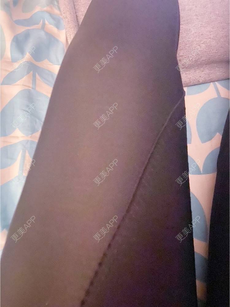 更美 - _ViViLee的吸脂经验 | 吸脂瘦大腿 | 超声溶脂瘦大腿 | 吸脂塑臀 | 吸脂 | 上海 | 射频溶脂瘦大腿 | 光纤溶脂瘦大腿