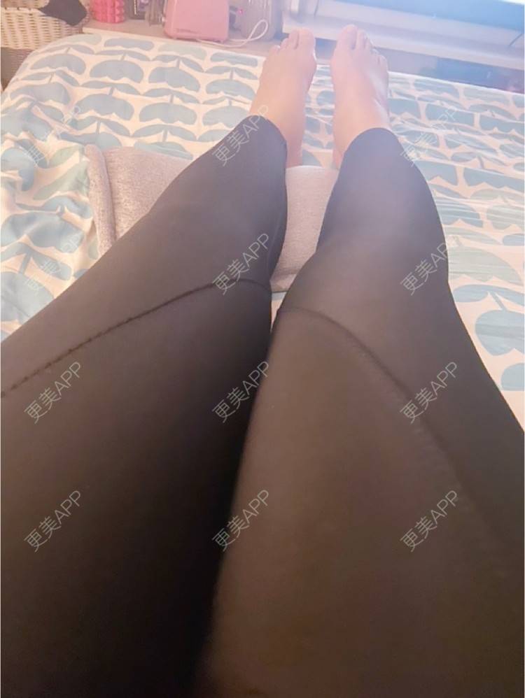 更美 - _ViViLee的吸脂经验 | 吸脂瘦大腿 | 超声溶脂瘦大腿 | 吸脂塑臀 | 吸脂 | 上海 | 射频溶脂瘦大腿 | 光纤溶脂瘦大腿