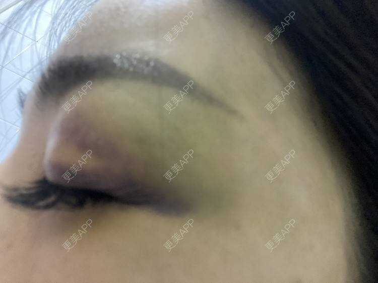 更美 - _ViViLee的自体脂肪丰太阳穴经验 | 自体脂肪丰太阳穴 | 自体脂肪垫眉弓 | 自体脂肪丰额头 | 上海