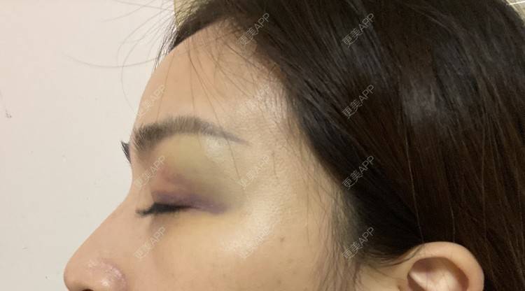 更美 - _ViViLee的自体脂肪丰太阳穴经验 | 自体脂肪丰太阳穴 | 自体脂肪垫眉弓 | 自体脂肪丰额头 | 上海