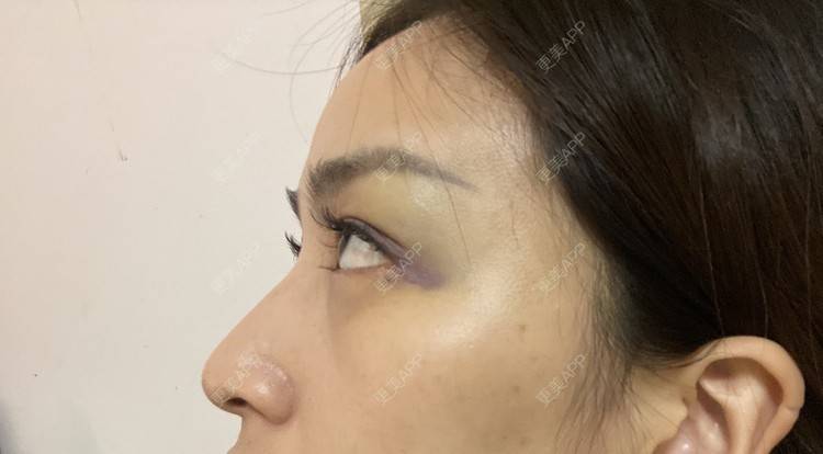 更美 - _ViViLee的自体脂肪丰太阳穴经验 | 自体脂肪丰太阳穴 | 自体脂肪垫眉弓 | 自体脂肪丰额头 | 上海