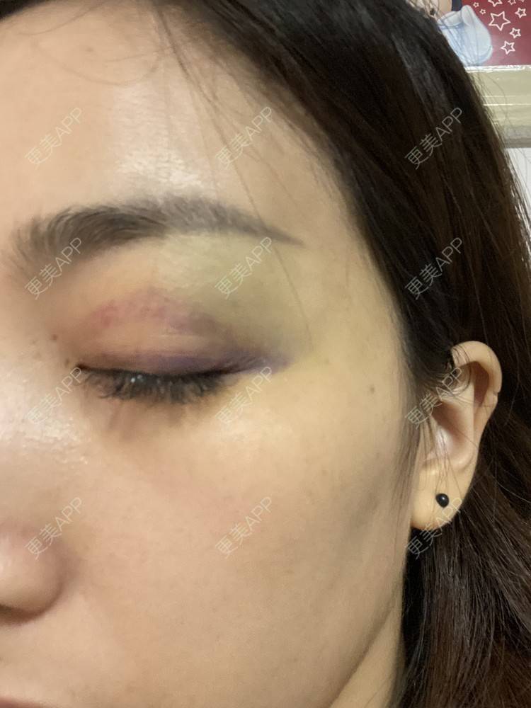 更美 - _ViViLee的自体脂肪丰太阳穴经验 | 自体脂肪丰太阳穴 | 自体脂肪垫眉弓 | 自体脂肪丰额头 | 上海