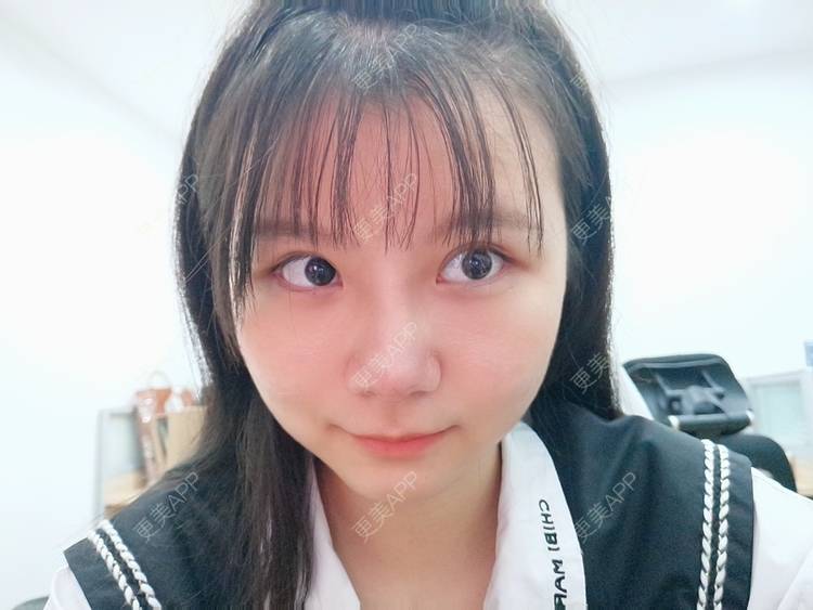 更美 - 更美用户GYLGovg47E的硅胶隆鼻经验 | 硅胶隆鼻 | 郑州