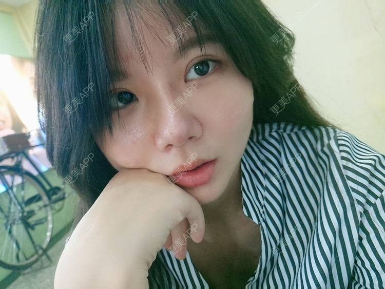 更美 - 更美用户GYLGovg47E的硅胶隆鼻经验 | 硅胶隆鼻 | 郑州