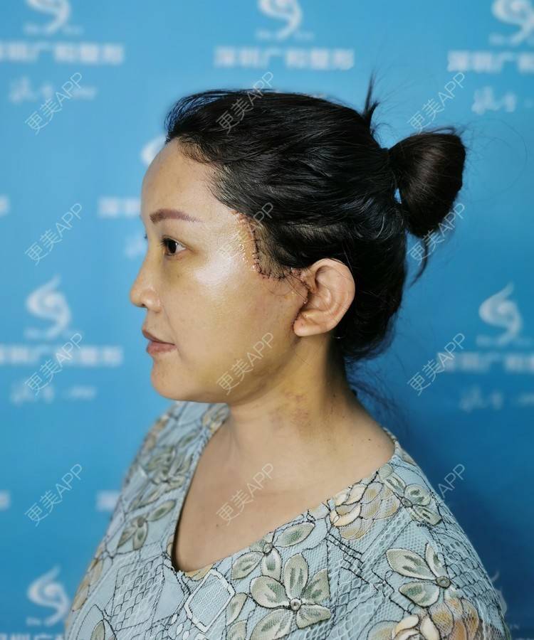 更美 - 风中摇曳着长发泳的小切口手术提升经验 | 小切口手术提升 | 除皱 | 深圳