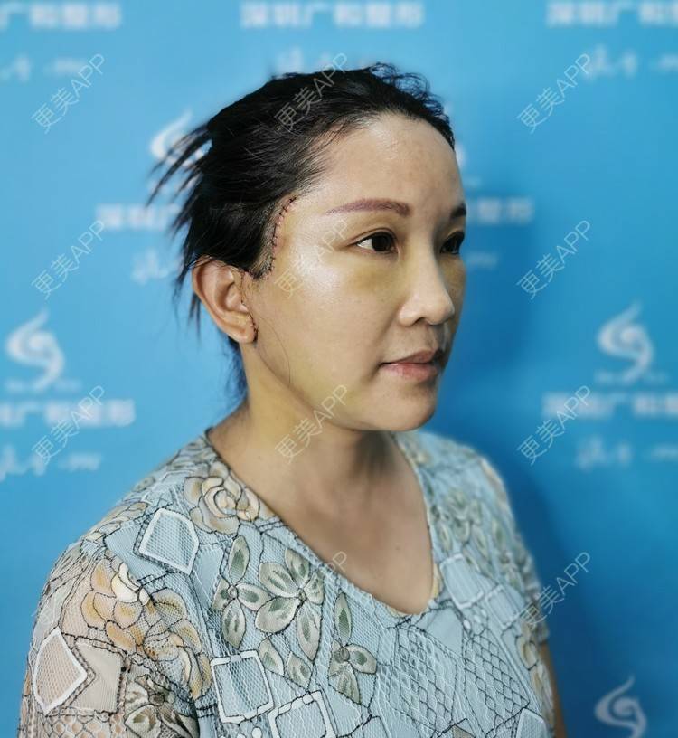 更美 - 风中摇曳着长发泳的小切口手术提升经验 | 小切口手术提升 | 除皱 | 深圳