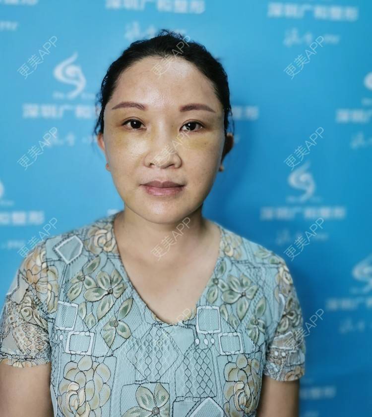 更美 - 风中摇曳着长发泳的小切口手术提升经验 | 小切口手术提升 | 除皱 | 深圳