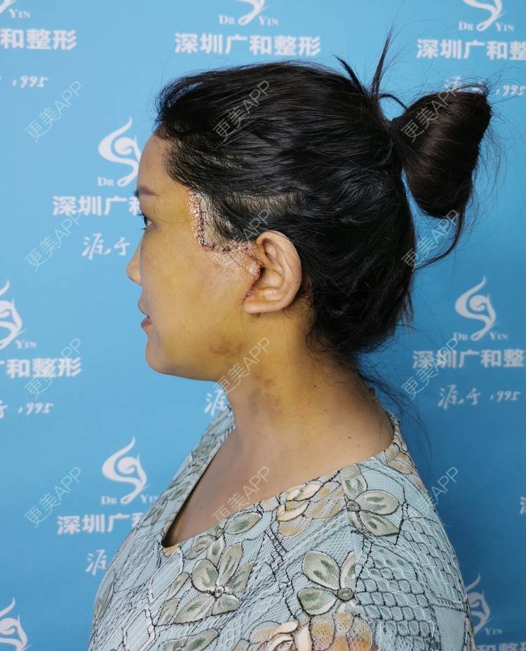 更美 - 风中摇曳着长发泳的小切口手术提升经验 | 小切口手术提升 | 除皱 | 深圳