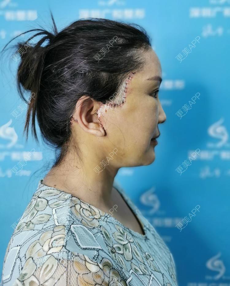 更美 - 风中摇曳着长发泳的小切口手术提升经验 | 小切口手术提升 | 除皱 | 深圳