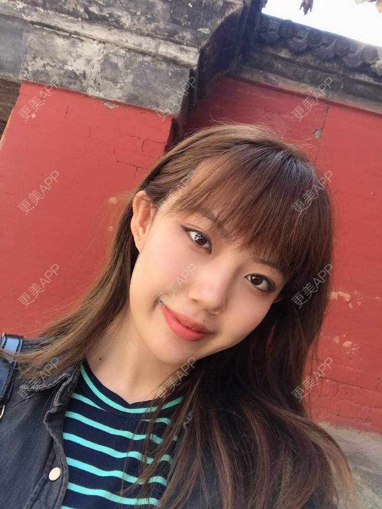 更美 - 更美用户Hvk5rcSs8n的鼻部多项经验 | 鼻部多项 | 鼻中隔软骨隆鼻 | 耳软骨隆鼻 | 哈尔滨