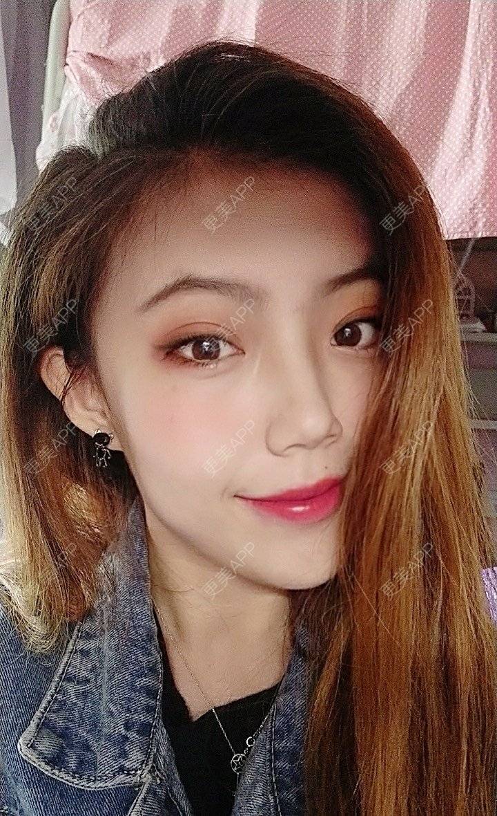 更美 - 更美用户Hvk5rcSs8n的鼻部多项经验 | 鼻部多项 | 鼻中隔软骨隆鼻 | 耳软骨隆鼻 | 哈尔滨
