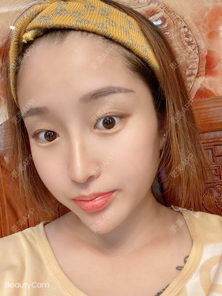 更美 - 小明你好我要美美1的鼻部多项经验 | 鼻部多项 | 广州 | 耳软骨隆鼻