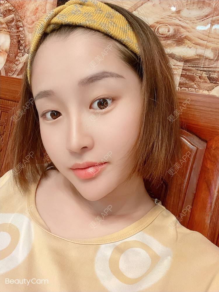 更美 - 小明你好我要美美1的鼻部多项经验 | 鼻部多项 | 广州 | 耳软骨隆鼻