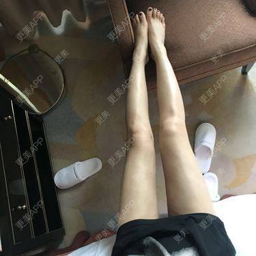 更美 - 更美用户gp0NZGMEnA的超声溶脂瘦大腿经验 | 超声溶脂瘦大腿 | 吸脂瘦大腿