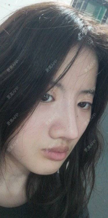 更美 - 更美用户e2aBOUZcGZ的额头经验 | 硅胶丰额头 | 额头 | 硅胶丰太阳穴 | 太阳穴 | 膨体丰额头 | 小切口手术提升