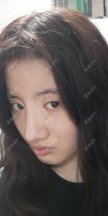更美 - 更美用户e2aBOUZcGZ的额头经验 | 硅胶丰额头 | 额头 | 硅胶丰太阳穴 | 太阳穴 | 膨体丰额头 | 小切口手术提升