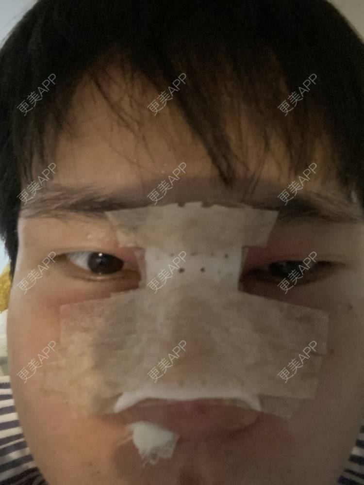 更美 - 冯仕琪的耳软骨隆鼻经验 | 济南 | 耳软骨隆鼻
