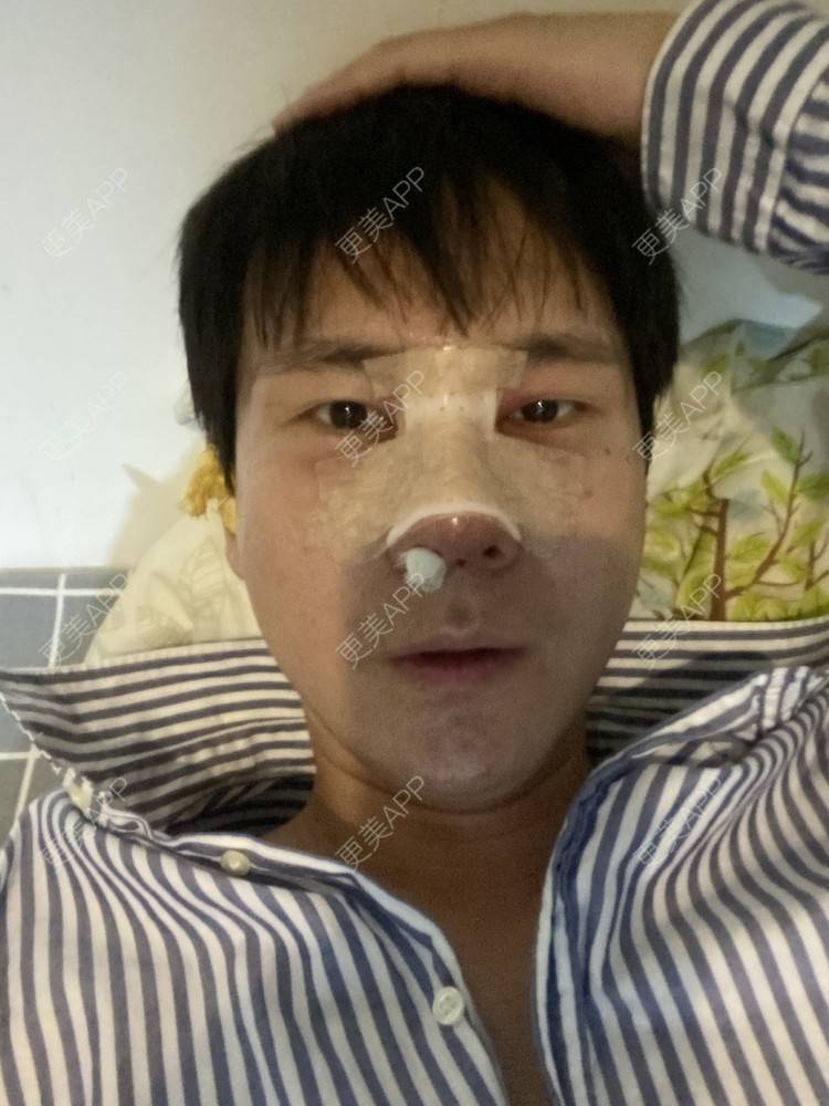 更美 - 冯仕琪的耳软骨隆鼻经验 | 济南 | 耳软骨隆鼻
