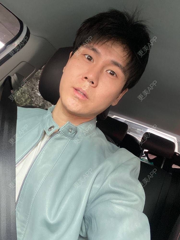 更美 - 冯仕琪的耳软骨隆鼻经验 | 济南 | 耳软骨隆鼻