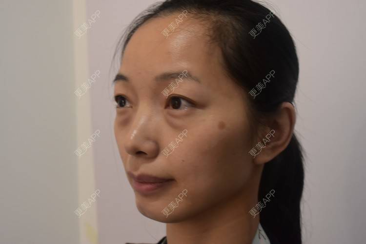更美 - 我是一只小小鸟🐦的内切去眼袋经验 | 内切去眼袋 | 激光去眼袋 | 北京