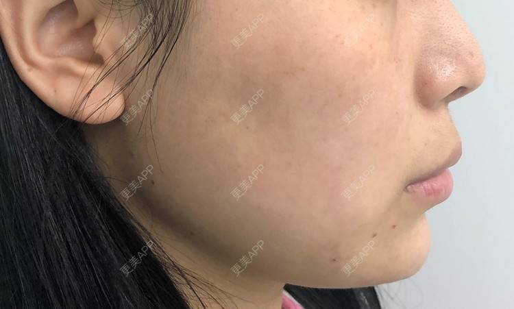 更美 - 更美用户PWF9hVwPH3的人中缩短经验 | 九江 | 人中缩短