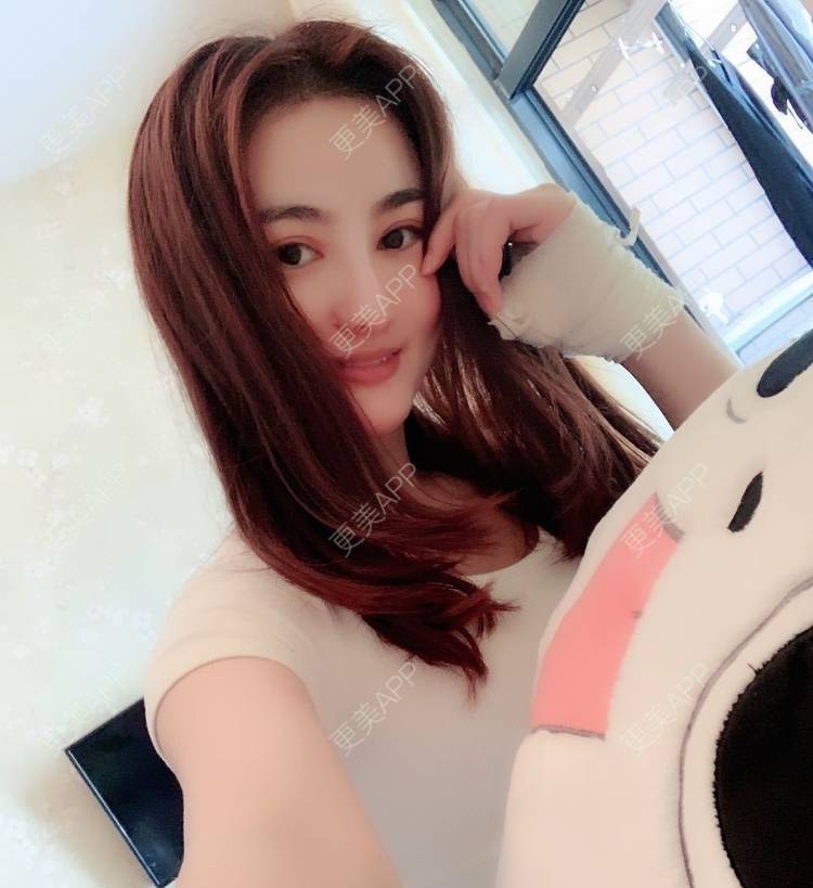 更美 - 更美用户tYzlahBO6T的植发际线经验 | 植发际线 | 深圳 | 毛发移植