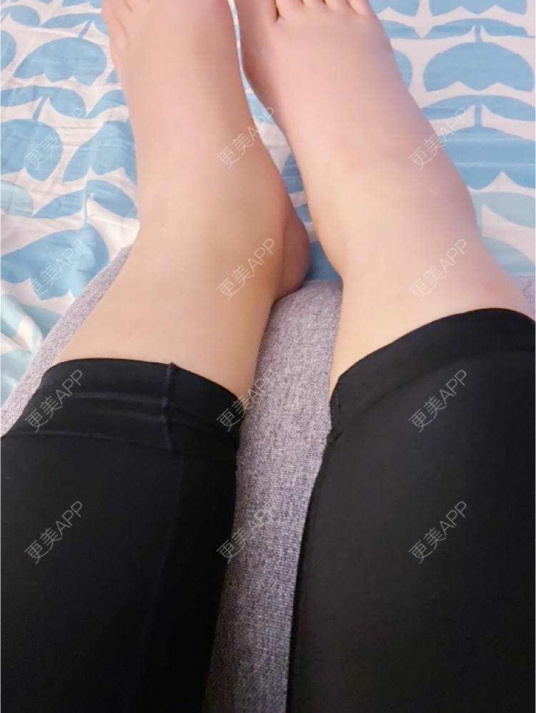 更美 - _ViViLee的吸脂经验 | 吸脂瘦大腿 | 吸脂塑臀 | 吸脂 | 上海 | 射频溶脂瘦大腿 | 超声溶脂瘦大腿 | 光纤溶脂瘦大腿