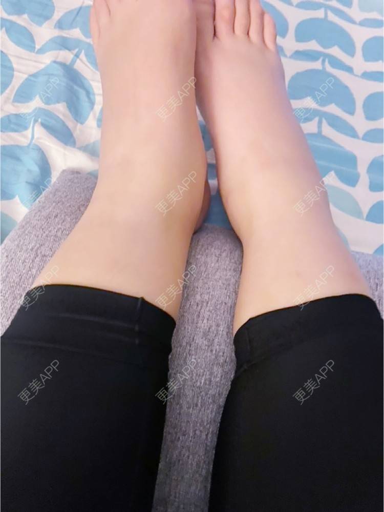 更美 - _ViViLee的吸脂经验 | 吸脂瘦大腿 | 吸脂塑臀 | 吸脂 | 上海 | 射频溶脂瘦大腿 | 超声溶脂瘦大腿 | 光纤溶脂瘦大腿