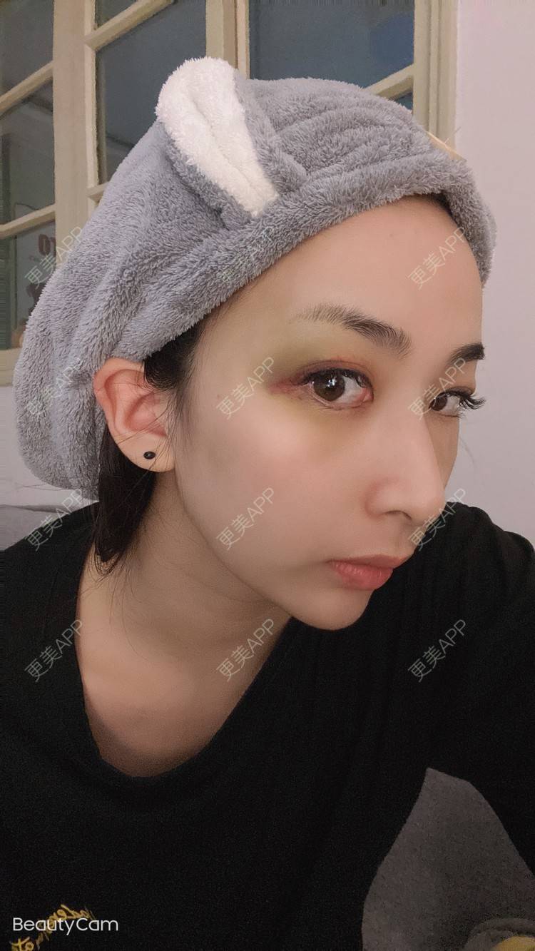 更美 - _ViViLee的自体脂肪丰太阳穴经验 | 自体脂肪丰太阳穴 | 自体脂肪丰额头 | 上海 | 自体脂肪垫眉弓