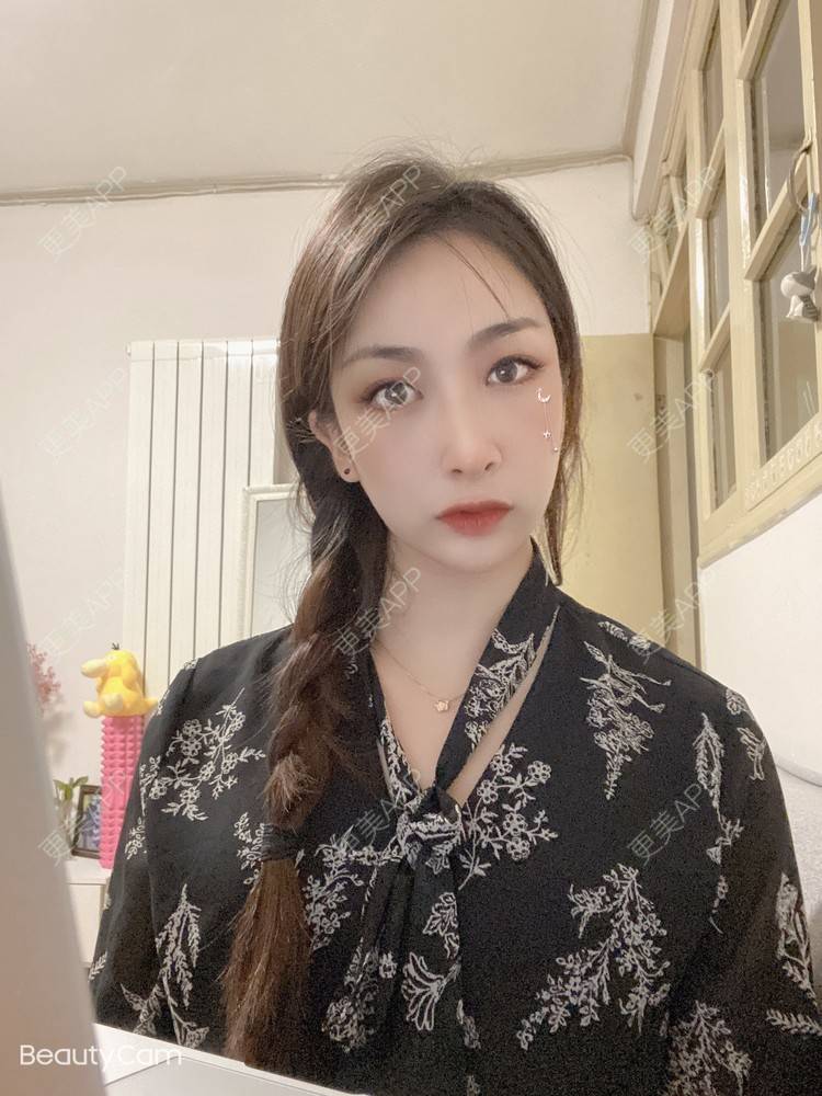 更美 - _ViViLee的自体脂肪丰太阳穴经验 | 自体脂肪丰太阳穴 | 自体脂肪丰额头 | 上海 | 自体脂肪垫眉弓