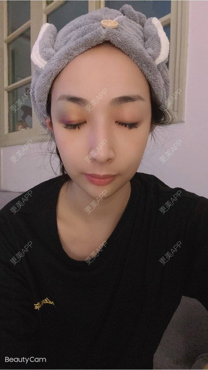 更美 - _ViViLee的自体脂肪丰太阳穴经验 | 自体脂肪丰太阳穴 | 自体脂肪丰额头 | 上海 | 自体脂肪垫眉弓