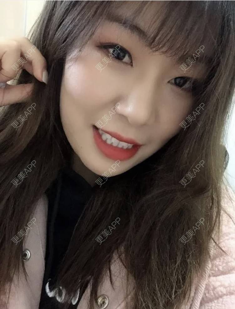 更美 - 路西佛的埋线提升经验 | 埋线提升 | 南昌