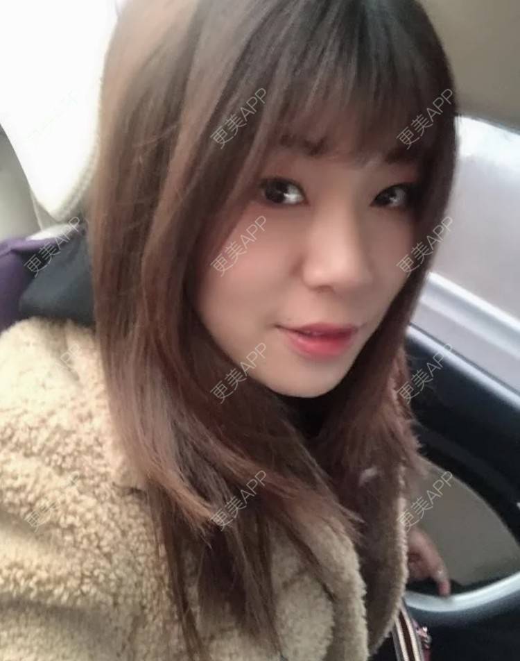 更美 - 路西佛的埋线提升经验 | 埋线提升 | 南昌