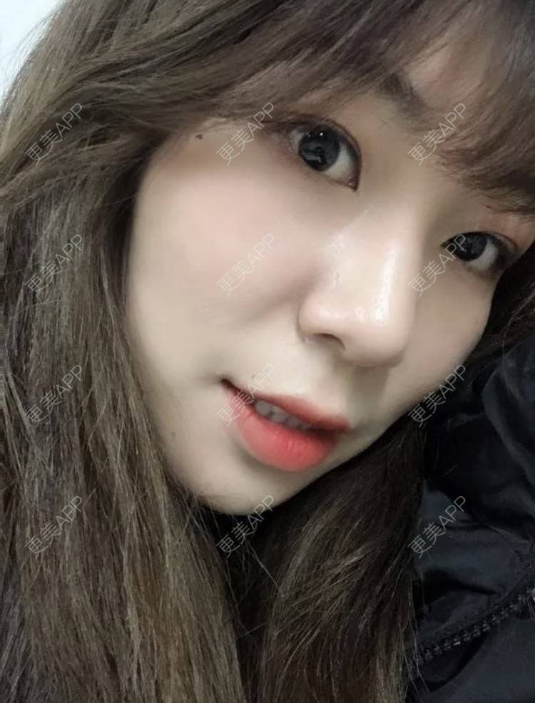 更美 - 路西佛的埋线提升经验 | 埋线提升 | 南昌