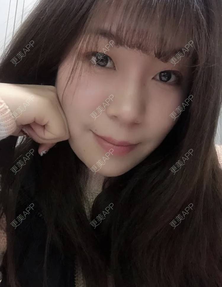 更美 - 路西佛的埋线提升经验 | 埋线提升 | 南昌