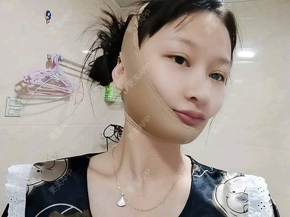更美 - 更美用户vzqIUiUnop的吸脂瘦脸经验 | 吸脂瘦脸 | 南京