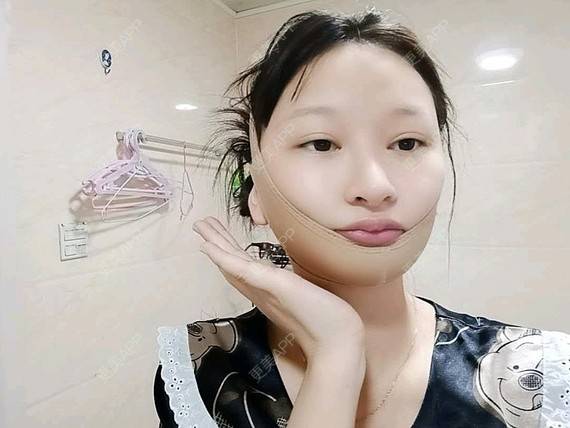 更美 - 更美用户vzqIUiUnop的吸脂瘦脸经验 | 吸脂瘦脸 | 南京