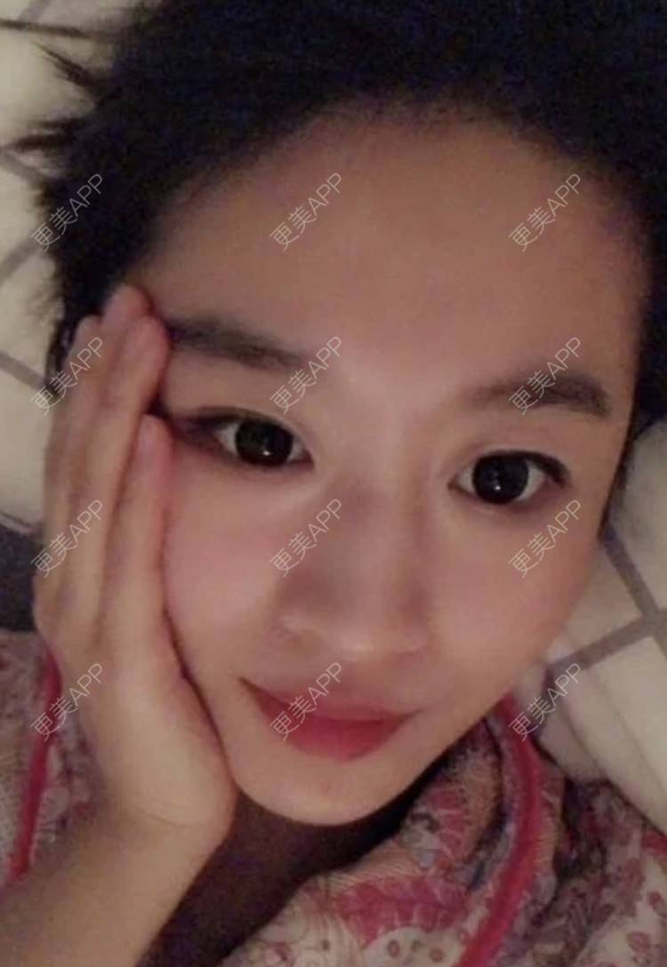 更美 - 繁星。。的埋线提升经验 | 埋线提升 | 南昌