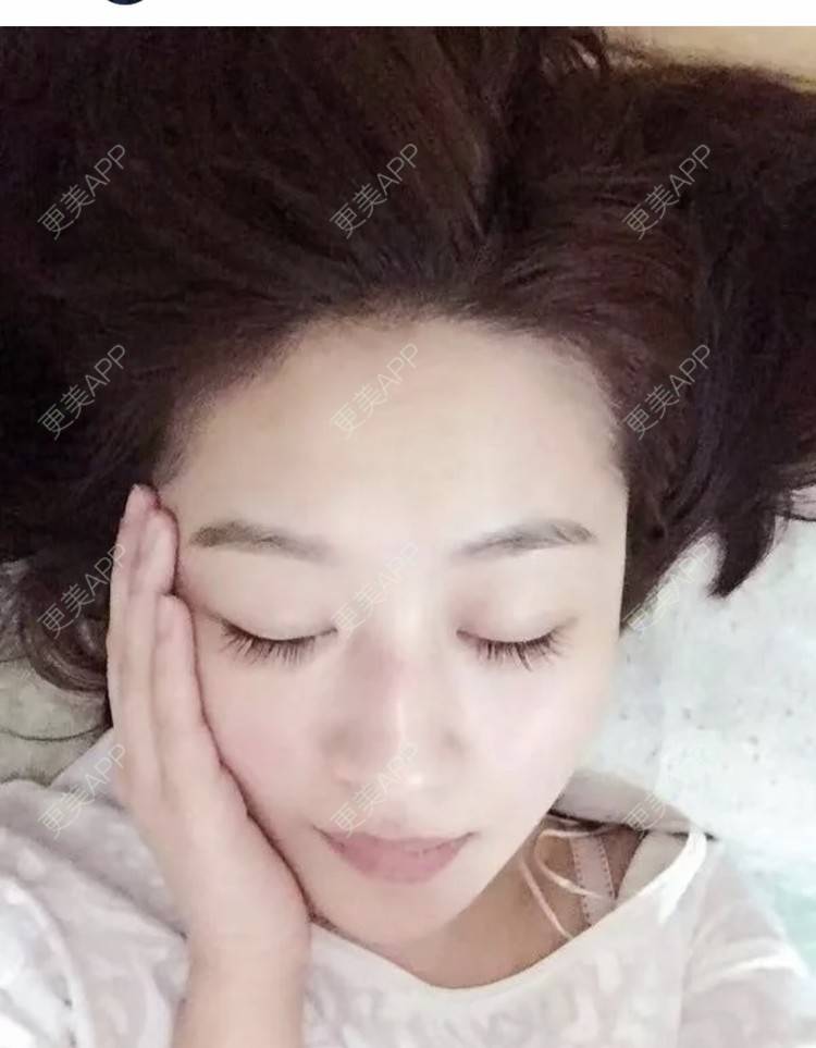 更美 - 繁星。。的埋线提升经验 | 埋线提升 | 南昌