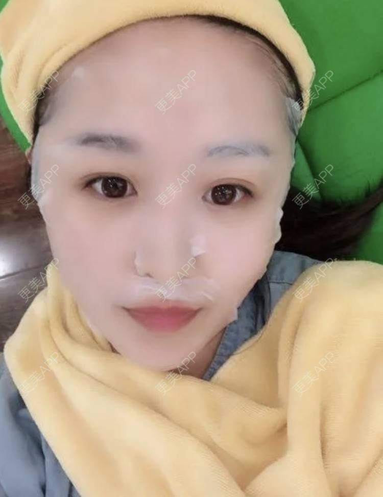 更美 - 繁星。。的埋线提升经验 | 埋线提升 | 南昌