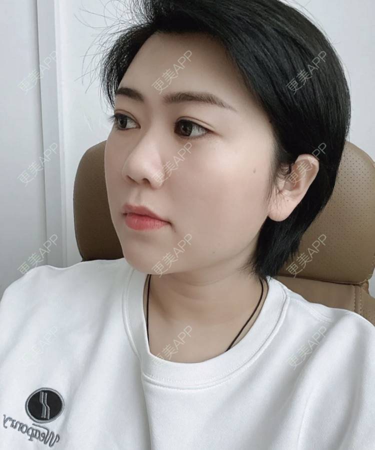 更美 - 路西佛的埋线提升经验 | 埋线提升 | 南昌