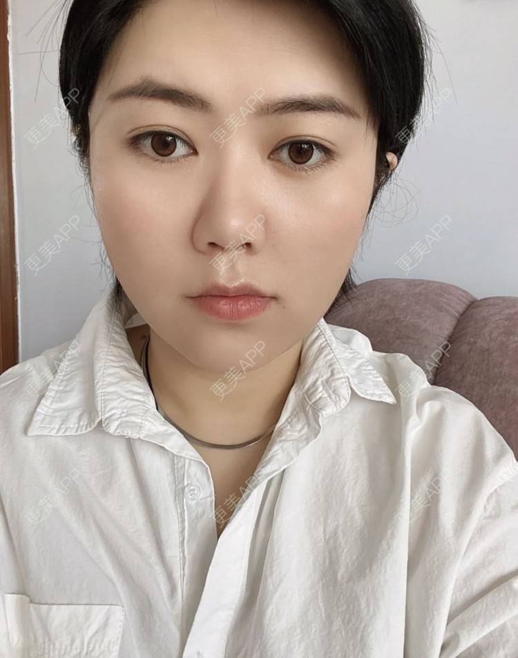 更美 - 路西佛的埋线提升经验 | 埋线提升 | 南昌