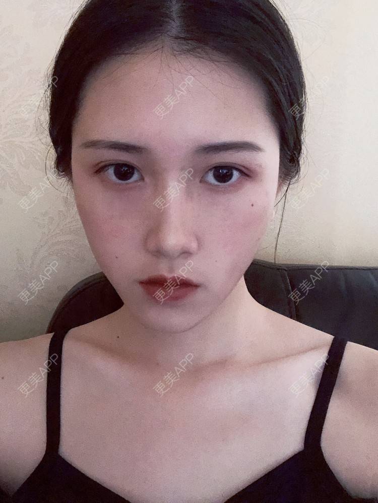 更美 - 更美用户ezaery6fSs的眼部多项经验 | 眼部多项 | 广州 | 视频日记