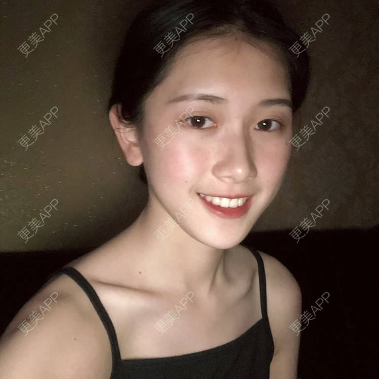 更美 - 更美用户ezaery6fSs的眼部多项经验 | 眼部多项 | 广州 | 视频日记