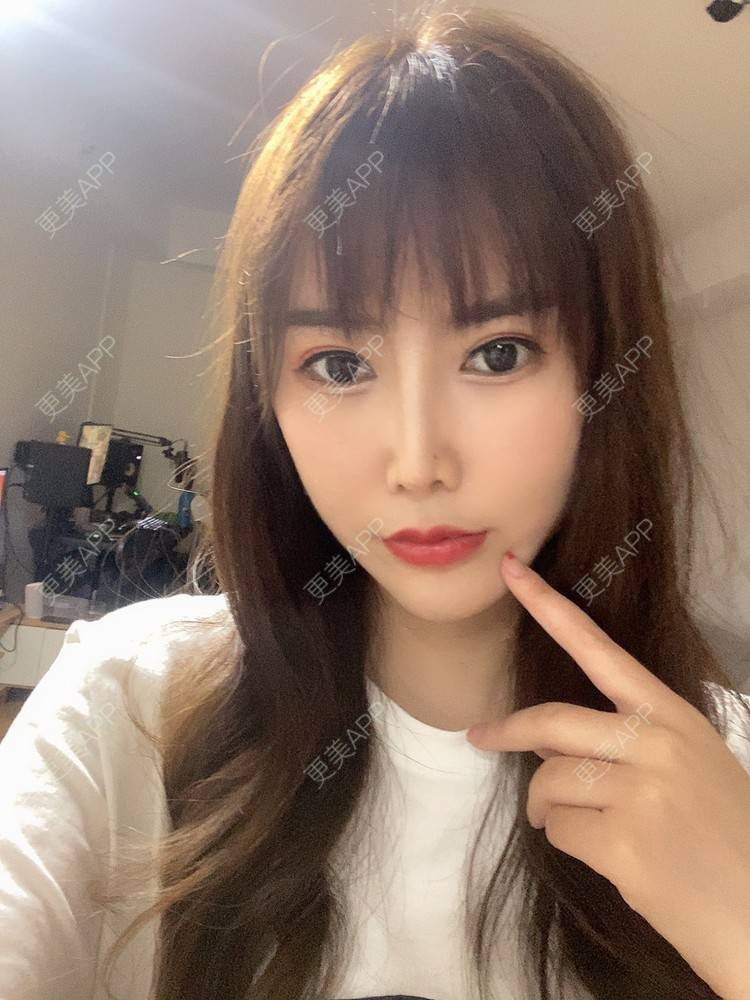 更美 - 明眸善睐666的玻尿酸唇部经验 | 玻尿酸唇部 | 成都 | 玻尿酸