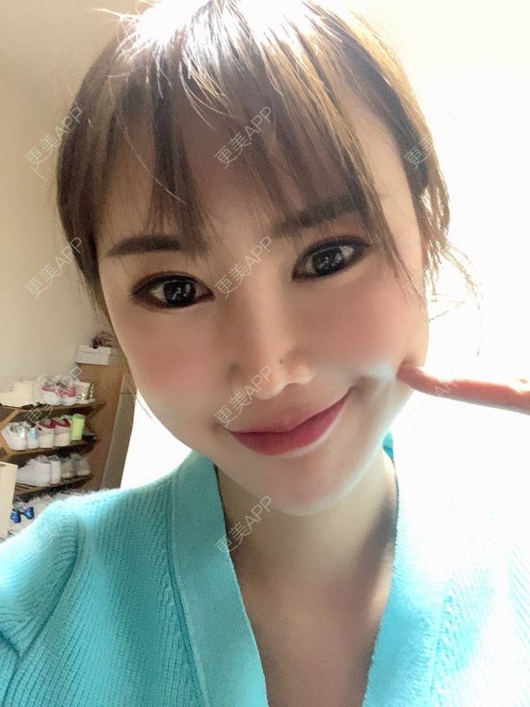 更美 - 明眸善睐666的玻尿酸唇部经验 | 玻尿酸唇部 | 成都 | 玻尿酸