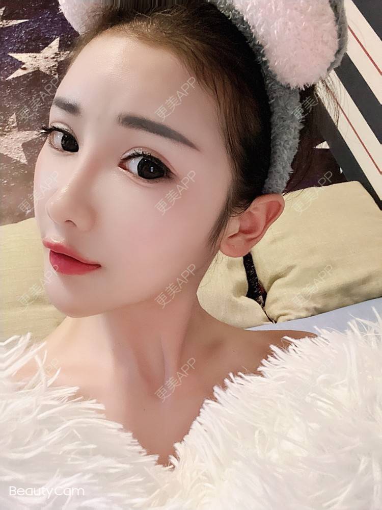 更美 - 酢乙女爱+花轮的除皱瘦脸经验 | 除皱瘦脸 | 玻尿酸全面部 | 南京