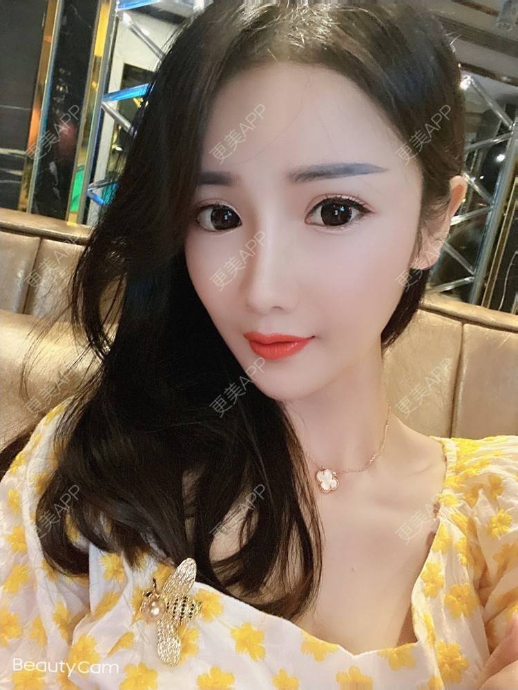 更美 - 酢乙女爱+花轮的除皱瘦脸经验 | 除皱瘦脸 | 玻尿酸全面部 | 南京