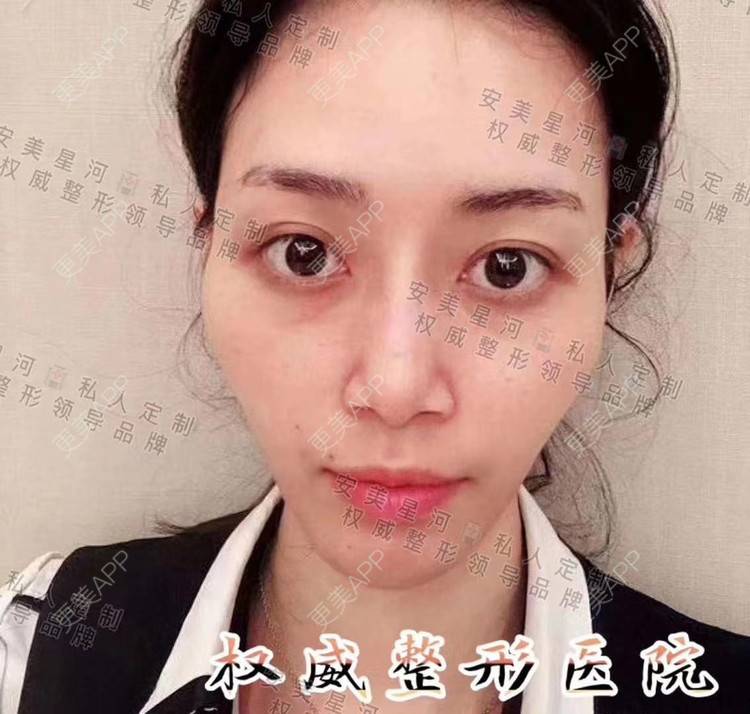 更美 - 郑州安美星河的双眼皮经验 | 双眼皮 | 注射美白 | 水光项目 | 隆鼻 | 郑州